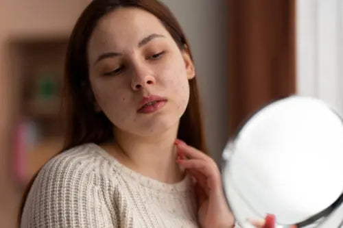 Understanding Hormonal Acne