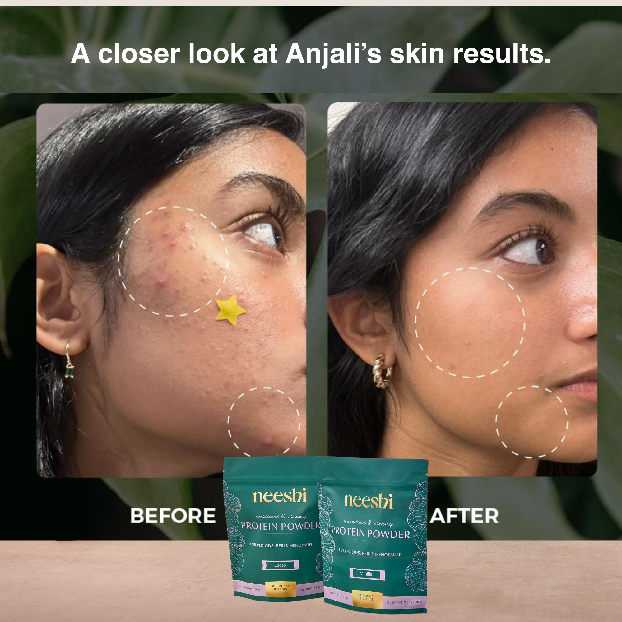 Before and After Hormonal Acne Skin Results